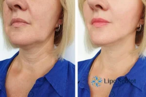 Double chin before and after Hi-Fu treatment 4 Book your double chin treatment Woburn Sands today! We are here to help!