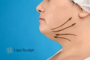 Double chin before and after Hi-Fu treatment 3 Boost your confidence with a Double chin treatment Woburn Sands