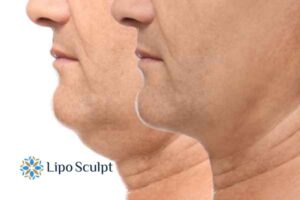 Double chin before and after Hi-Fu treatment 2 Double chin treatment Woburn Sands from Lipo Sculpt - feel more confident today!