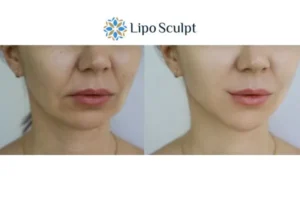 Explaining Total Skin Tightening Treatment And What It Can Do For You 2 Do you want to boost your self confidence? Give Morpheus8 Woburn Sands a try today!
