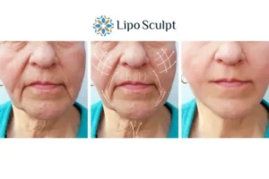 Explaining Total Skin Tightening Treatment And What It Can Do For You 3 Boost your confidence with Morpheus8 Woburn Sands call our team today!
