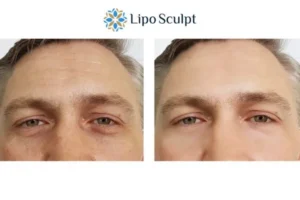 Explaining Total Skin Tightening Treatment And What It Can Do For You 6 Morpheus8 Woburn Sands book in today to find out more!