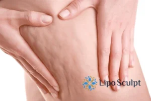 CoolSculpting for Legs: The Innovative Approach to Redefining Your Legs 5 Start your journey today book your coolsculpting treatment Woburn Sands online today!