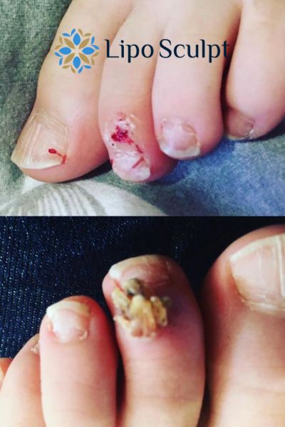 Wart removal customer results from Lipo Sculpt Woburn Sands