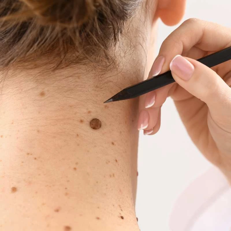 How to Support Your Body During Pregnancy for Faster Postnatal Recovery 5 See our lesion removal prices Woburn Sands - call today for a free quote