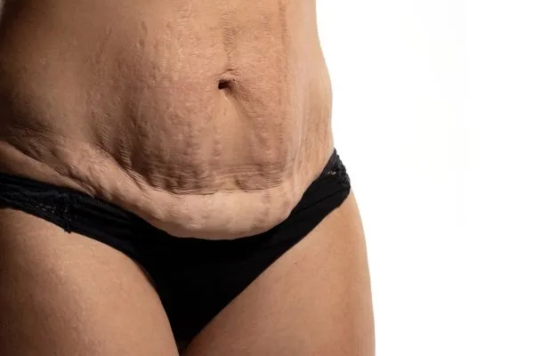 Lost the Weight but Not the Loose Skin? 1 image of womans stomach after weight loss showing loose skin Woburn Sands